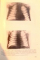 ATLAS DE RADIOLOGIE PEDIATRICA de Z.FRUCHTER...I.TUDOSIU 1965