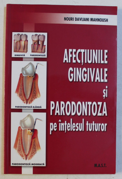 AFECTIUNILE GINGIVALE SI PARODONTOZA PE INTELESUL TUTUROR de NOURI DAVIJANI MAHNOUSH , 2007