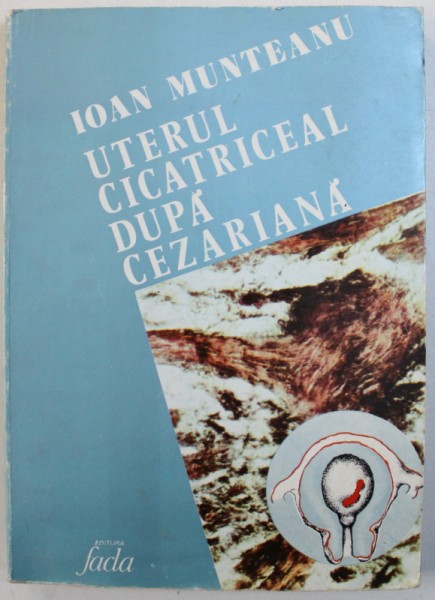 UTERUL CICATRICEAL DUPA CEZARIANA de IOAN MUNTEANU , 1985
